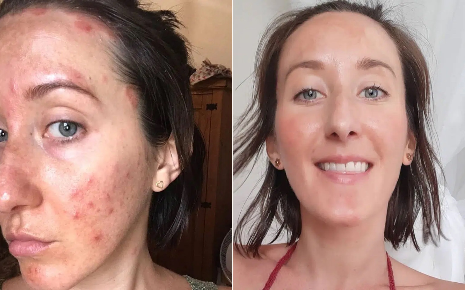 Two photographs of Jodie Louise side by side, her face during the worst of her cystic acne and psoriasis, and her skin years later