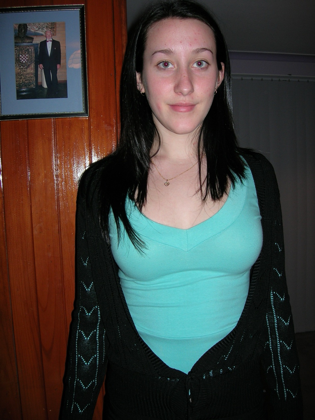 Jodie Louise as a teenager, her skin breaking out